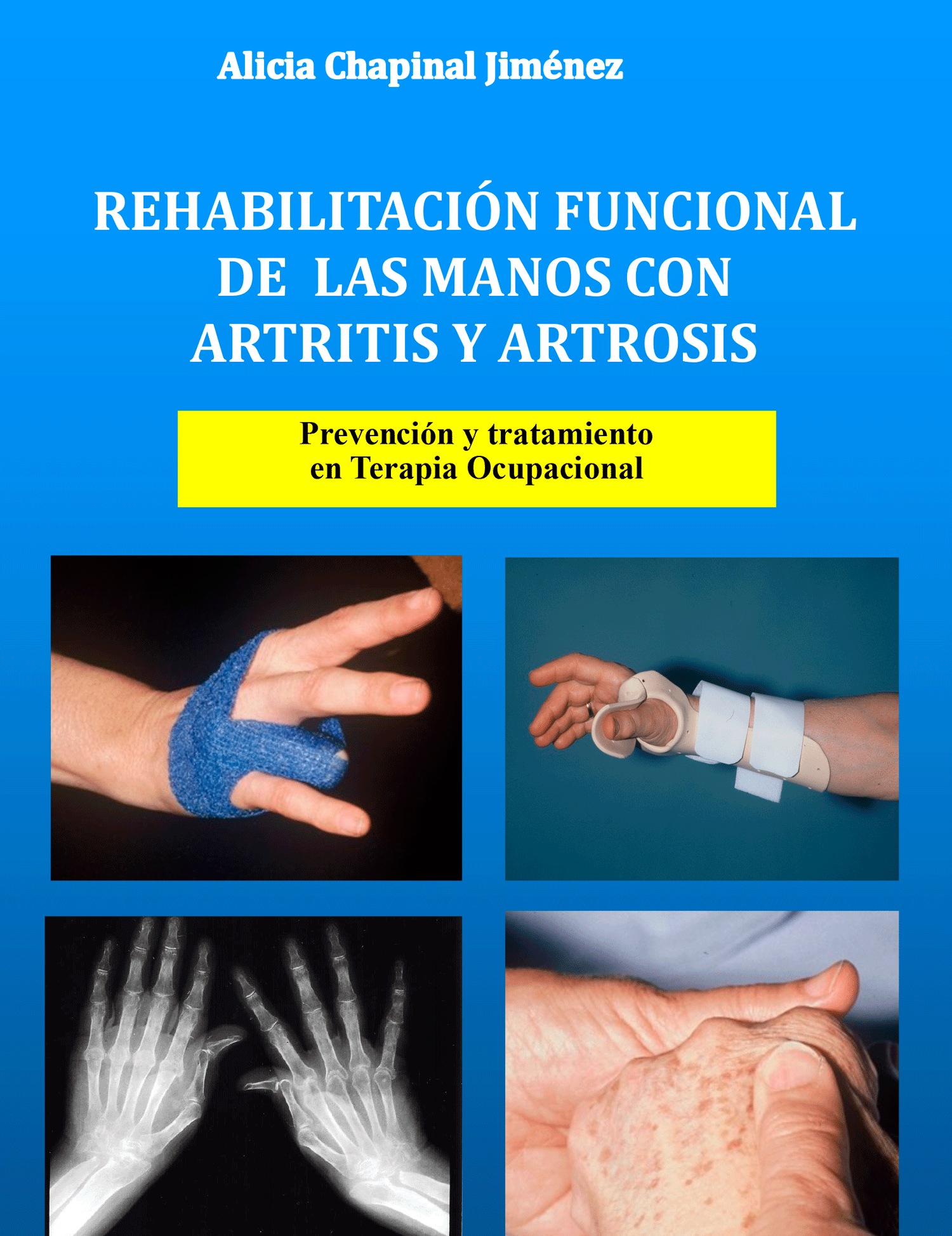 Artrosis o Artritis?: Gimnasia para manos – CDI Marbella